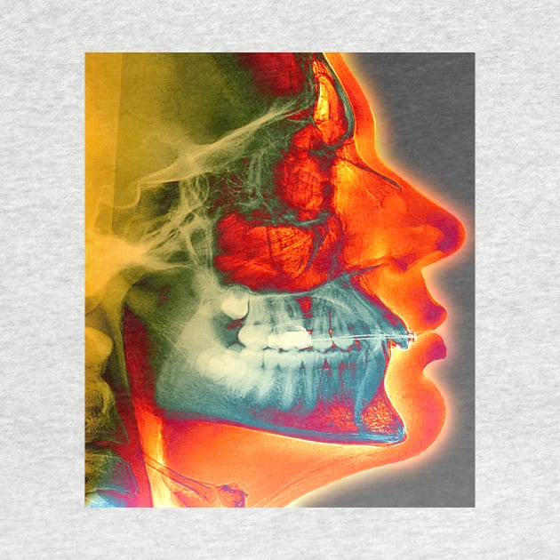 Orthodontic brace X-ray (M780/0342) by SciencePhoto